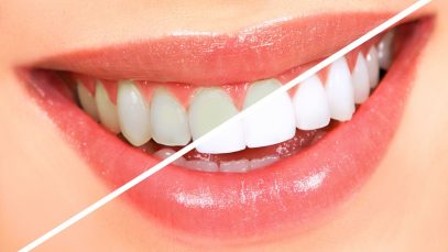 5 Fastest Teeth Whitening Methods