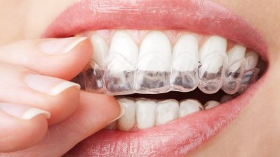 What are Clear Aligners