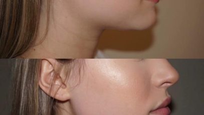 What are jawline fillers