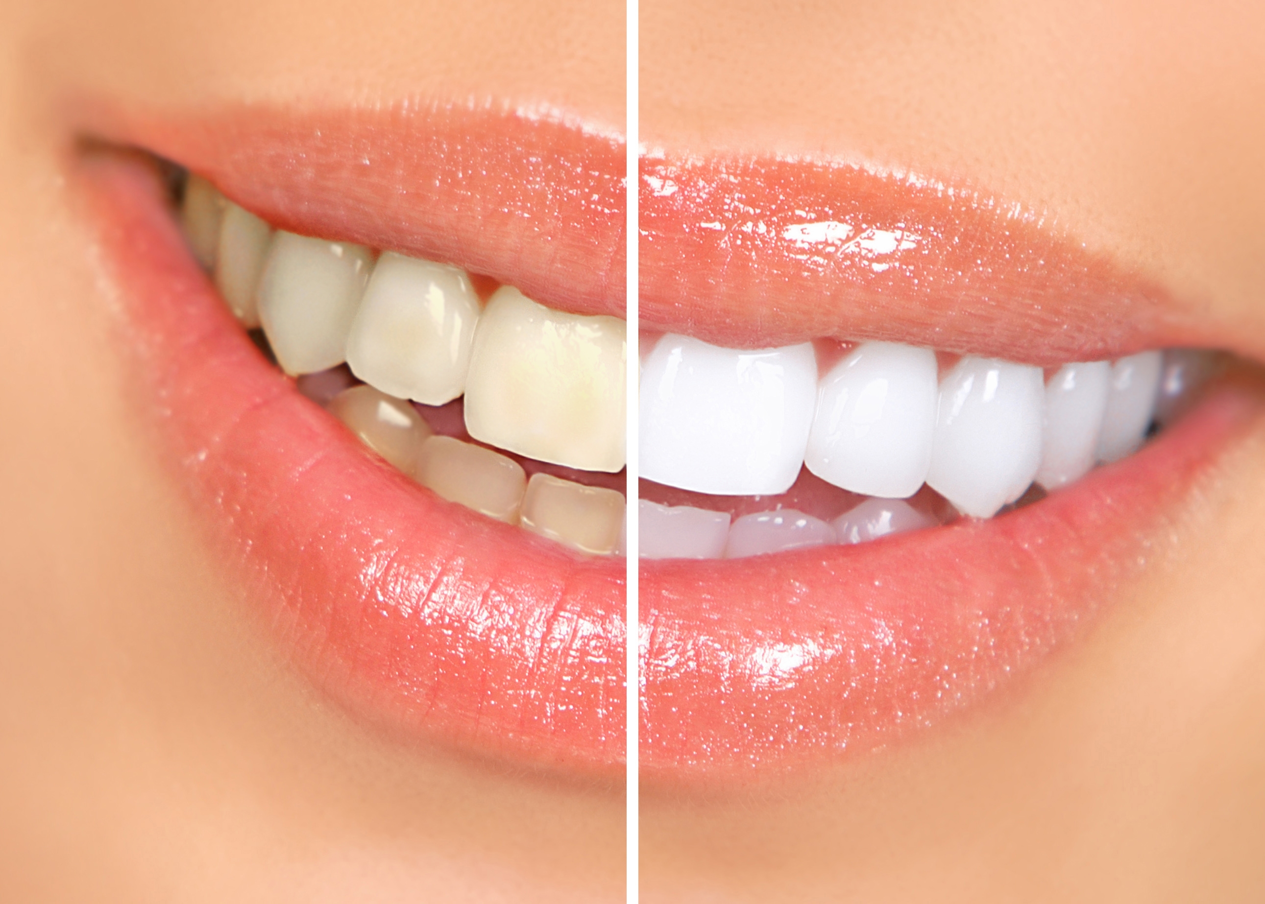 How To Use Whitening Teeth Strips at Michael Garcia blog