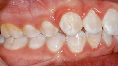 White spots on baby teeth
