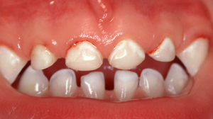 White Spots on Teeth: In Children, While Sick, and More