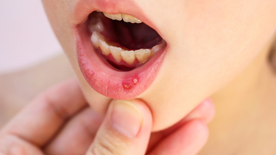 mouth-ulcer-wikipedia