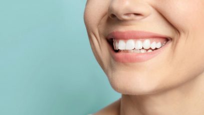 What Are Porcelain Veneers?