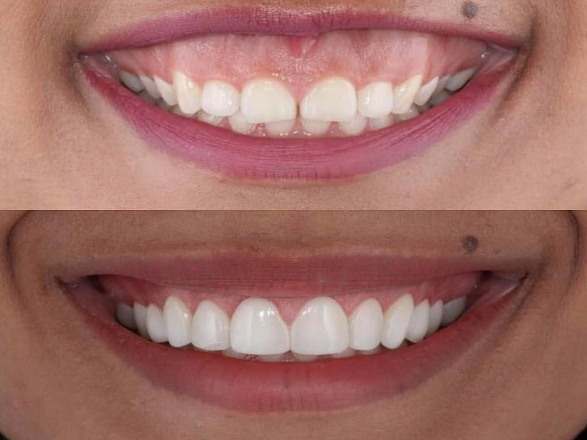 atlanta-ga-gummy-smile-correction-sandy-springs-gum-reshaping